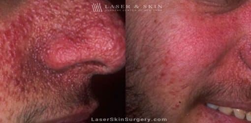 Laser Treatment for Tuberous Sclerosis (Angiofibromas)