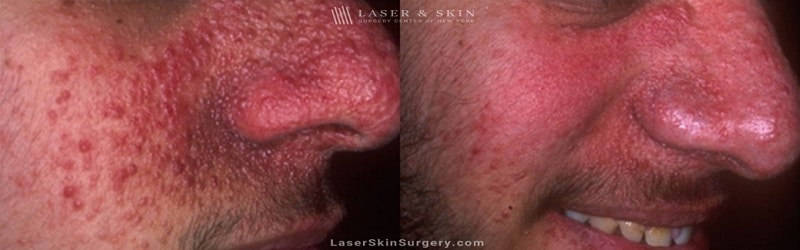 before and after image of a laser treatment for Tuberous Sclerosis angiofibromas on a man's face