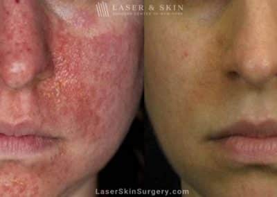 Laser Treatment for Tuberous Sclerosis (Angiofibromas)