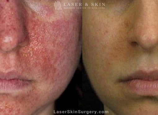 Laser Treatment for Tuberous Sclerosis (Angiofibromas)