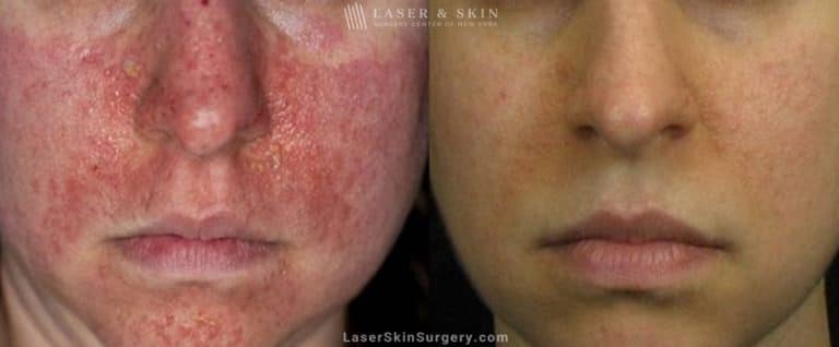 Laser Treatment for Tuberous Sclerosis (Angiofibromas)