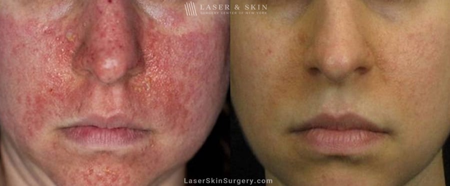 before and after image of a laser treatment for Tuberous Sclerosis angiofibromas on a woman's face