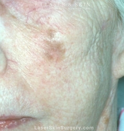 lsscny example of malignant melanoma on cheek new york, ny lsscny example of malignant melanoma on cheek new york, ny