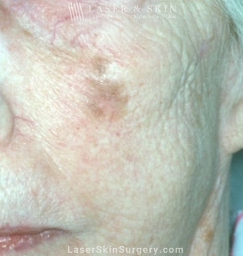 lsscny example of malignant melanoma on cheek new york, ny