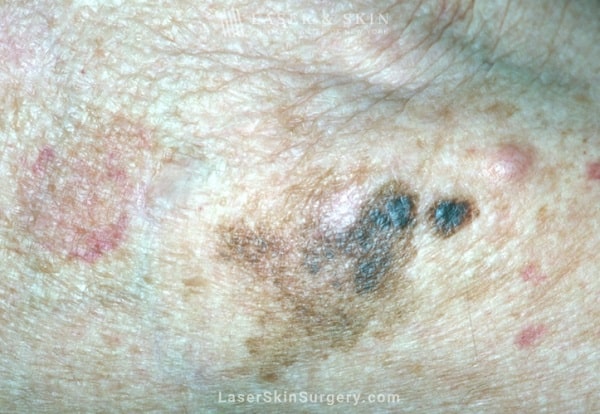 Laser & Skin Surgery Center of New York Malignant Melanoma New York City, NY Laser & Skin Surgery Center of New York Malignant Melanoma New York City, NY