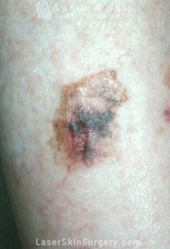 lsscny example lentigo maligna melanoma new york, ny