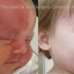 Pulsed Dye Laser Treatment of Port-Wine Stains in Infancy Without the Need for General Anesthesia