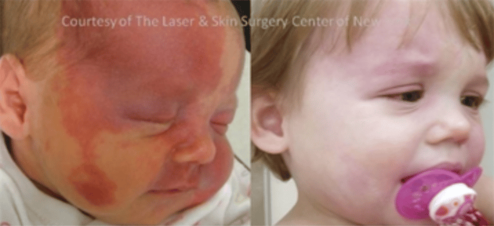 pulsed dye laser treatment results