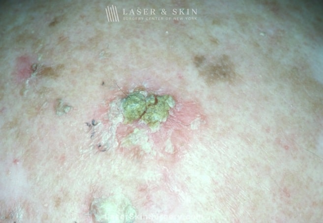 Laser & Skin Surgery Center of New York Squamous Cell Carcinoma New York City, NY Laser & Skin Surgery Center of New York Squamous Cell Carcinoma New York City, NY