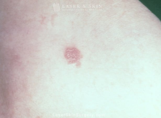 lsscny photo of squamous cell carcinoma on skin new york, ny