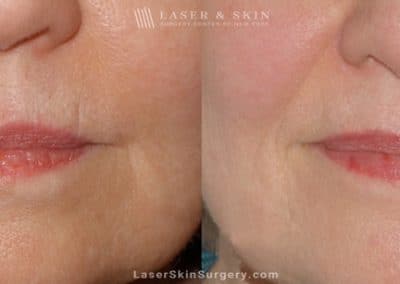 Ultherapy to Treat Sagging Skin, Lines and Wrinkles on the Face and Neck