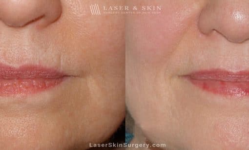 Ultherapy to Treat Sagging Skin, Lines and Wrinkles on the Face and Neck