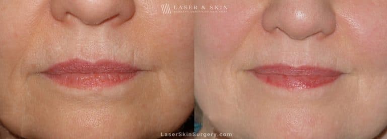 Ultherapy to Treat Sagging Skin, Lines and Wrinkles on the Face and Neck