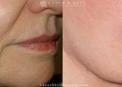 Ultherapy to Treat Sagging Skin, Lines and Wrinkles on the Face and Neck