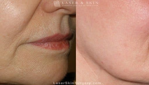 Ultherapy to Treat Sagging Skin, Lines and Wrinkles on the Face and Neck