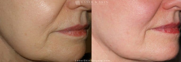 Ultherapy to Treat Sagging Skin, Lines and Wrinkles on the Face and Neck