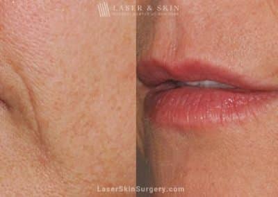 Ultherapy to Treat Sagging Skin, Lines and Wrinkles on the Face and Neck