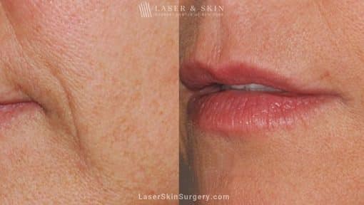 Ultherapy to Treat Sagging Skin, Lines and Wrinkles on the Face and Neck