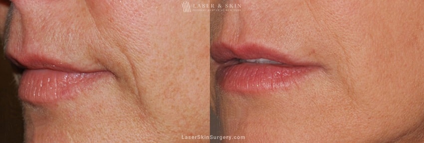 ultherapy-laser-treatment-to-improve-facial-lines-wrinkles-new-york-new-york-2741 ultherarpy before and after photo in new york city