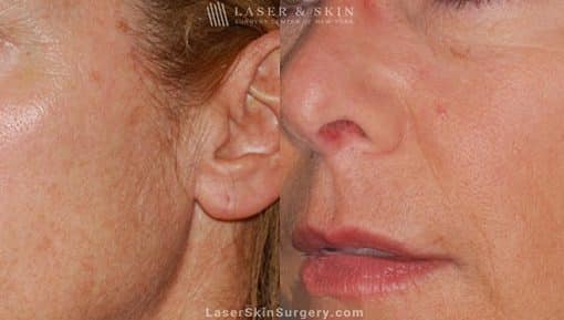 Ultherapy to Treat Sagging Skin, Lines and Wrinkles on the Face and Neck