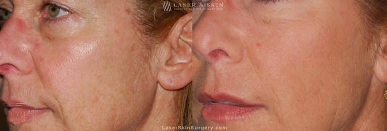 Ultherapy to Treat Sagging Skin, Lines and Wrinkles on the Face and Neck