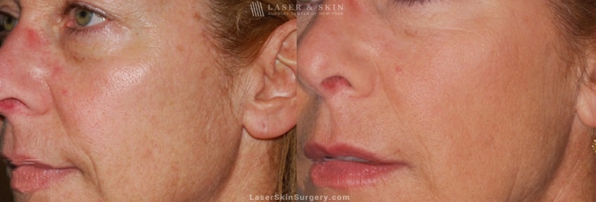 before and after image of an Ultherapy laser treatment for sagging skin and facial lines and wrinkles