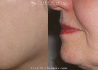 Ultherapy to Treat Sagging Skin, Lines and Wrinkles on the Face and Neck