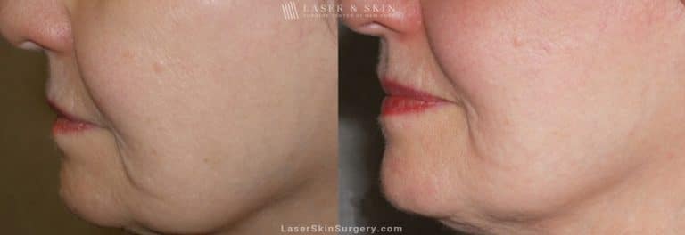 Ultherapy to Treat Sagging Skin, Lines and Wrinkles on the Face and Neck