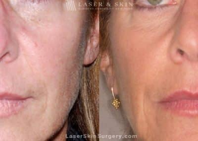 Ultherapy to treat sagging skin, lines and wrinkles on the face and neck