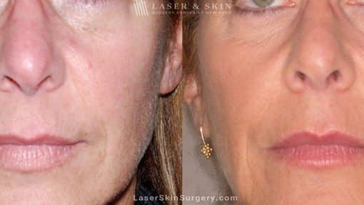 Ultherapy to treat sagging skin, lines and wrinkles on the face and neck