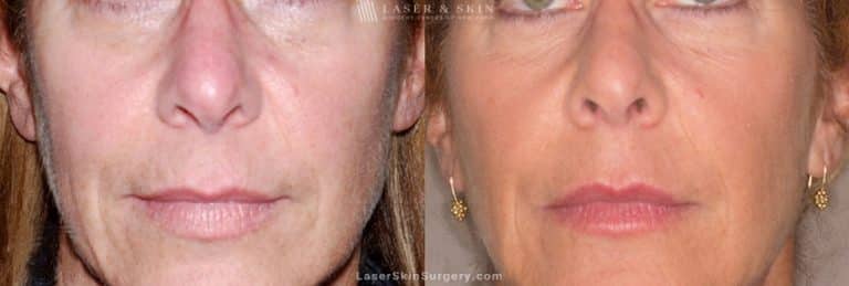 Ultherapy to treat sagging skin, lines and wrinkles on the face and neck