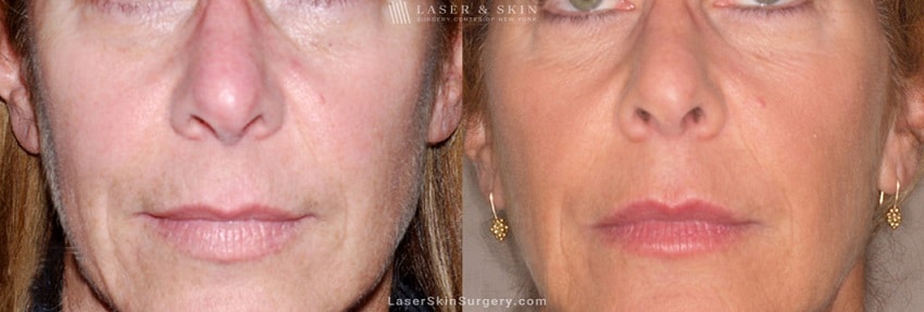 before and after image of an Ultherapy laser treatment for sagging skin and facial lines and wrinkles