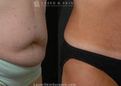 Abdominoplasty to Reduce Midsection