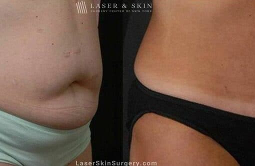 Abdominoplasty to Reduce Midsection