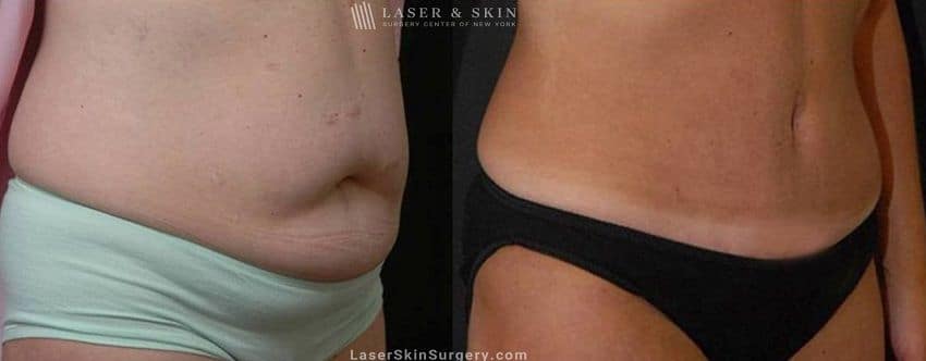 Abdominoplasty-to-reduce-midsection-New-York-City-NYC-1 flat stomach after a tummy tuck procedure