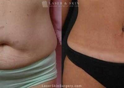 Abdominoplasty to Reduce Midsection