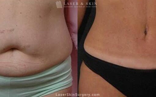 Abdominoplasty to Reduce Midsection