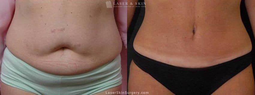 Abdominoplasty-to-reduce-midsection-New-York-City-NYC-2 tummy tuck results on a female patient