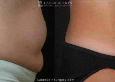Abdominoplasty to Reduce Midsection