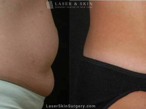 Abdominoplasty to Reduce Midsection