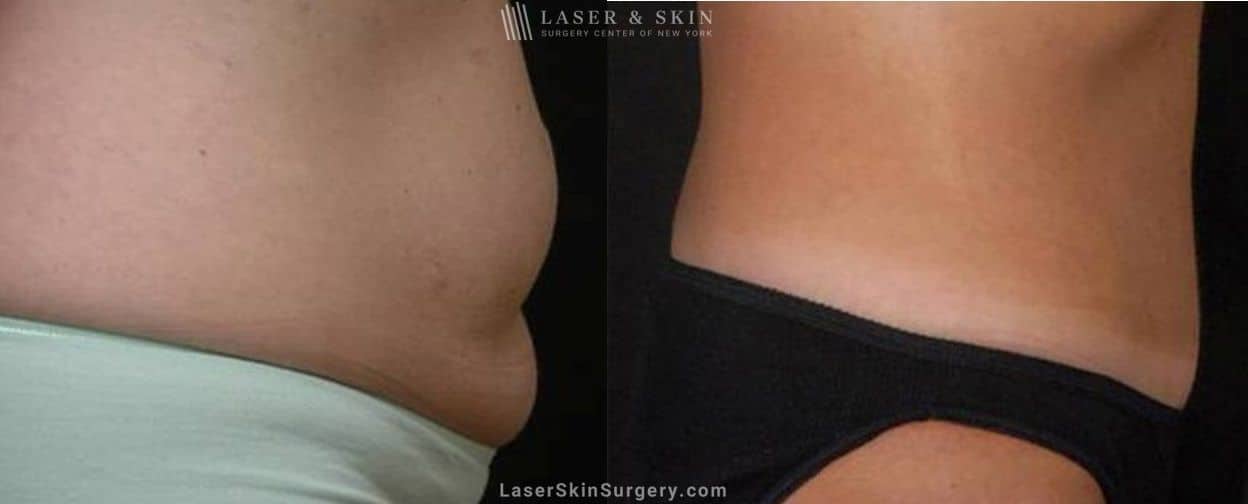 Abdominoplasty-to-reduce-midsection-New-York-City-NYC flat stomach after a tummy tuck in nyc
