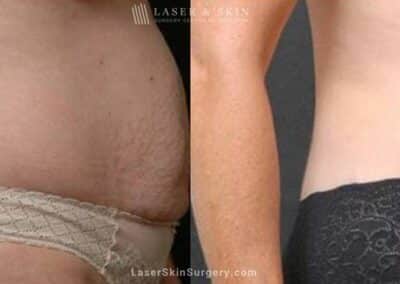 Abdominoplasty to Sculpt Midsection