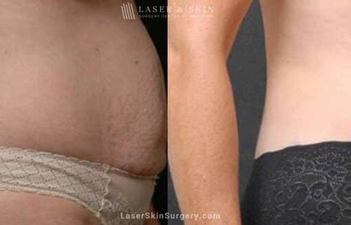 Abdominoplasty to Sculpt Midsection