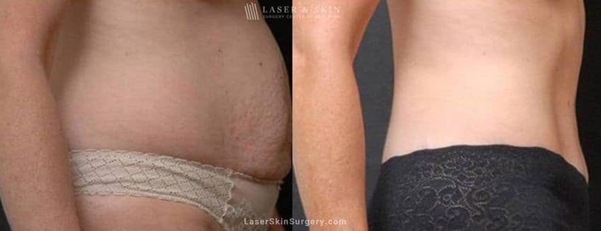 lsscny Abdominoplasty to sculpt midsection before and after new york ny