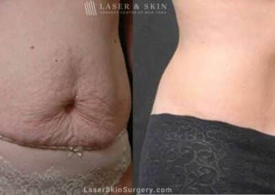 Abdominoplasty to Sculpt Midsection