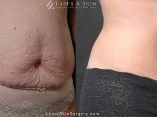 Abdominoplasty to Sculpt Midsection