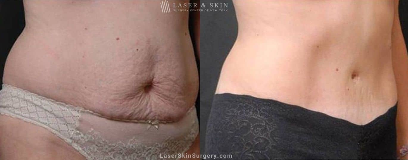 tummy tuck before and after