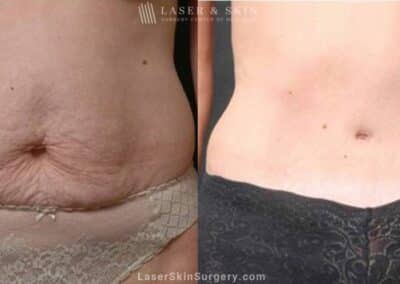 Abdominoplasty to Sculpt Midsection