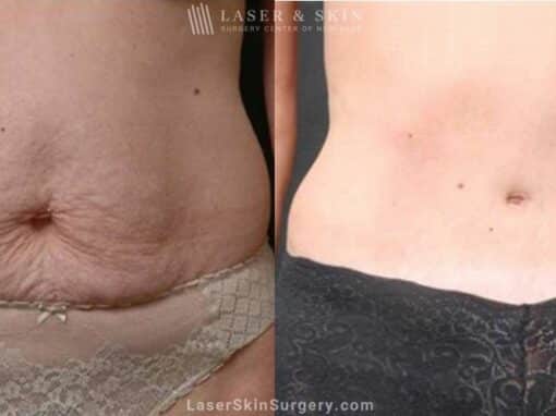 Abdominoplasty to Sculpt Midsection