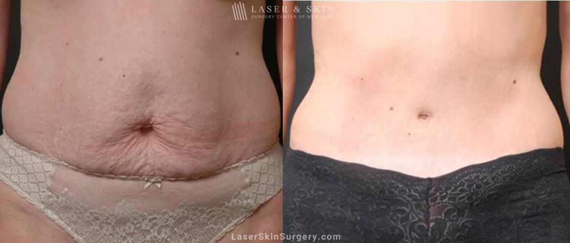 tummy tuck on a female patient